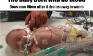 Acest copil e un MIRACOL. S-a născut fără nicio picătură de SÂNGE în corp şi totuşi trăieşte
