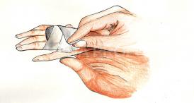 Sfaturi în cazul arsurilor Arsurile. Cum tratăm rănile provocate de căldură și electricitate